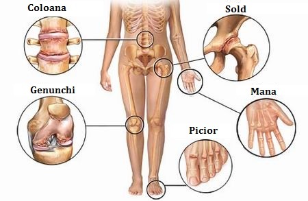 tratamentul osteoartritei tratament pt artrita la picior